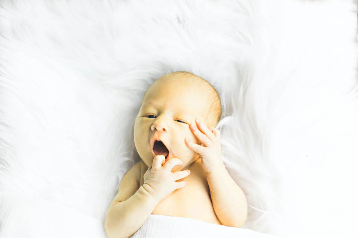 baby jaundice pictures